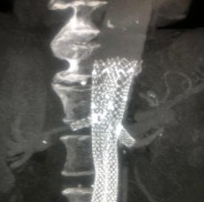 Fenestrated Altura™ - FEVAR used to treat a previously surgical bifurcated graft